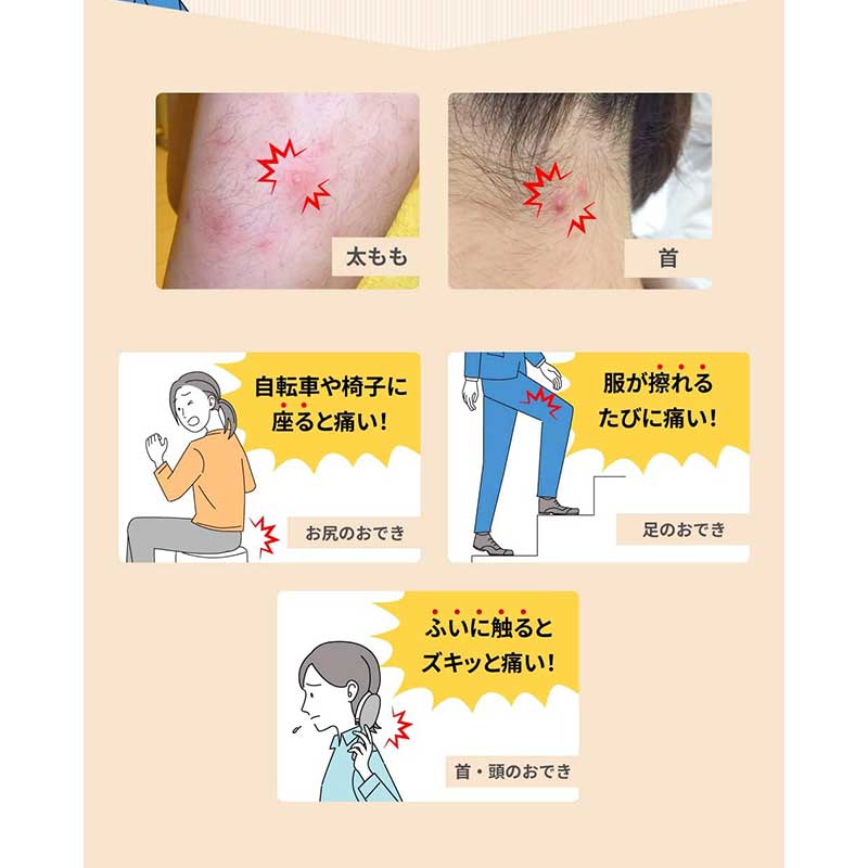 池田模範堂 MUHI 癤子 膿包治療藥EX 12g- 讓您擁有清爽健康的肌膚！[第2類醫藥品]