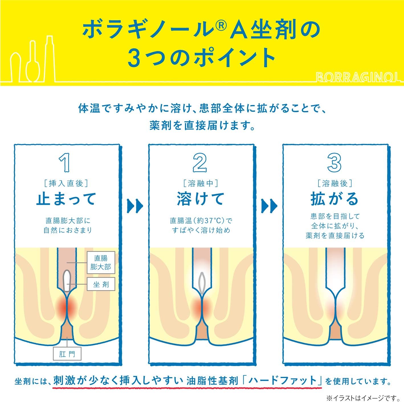 天藤製藥 保能痔Borraginol A系列 痔瘡藥 栓劑[指定第2類醫藥品]